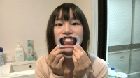 【歯科医師治療映像】年齢の割りに大量の歯石がこびりついたフリーターの歯石除去治療【特選画像53枚付】