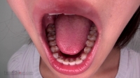 フェチ：はるかちゃんの口内・矯正歯観察（通常版＋３Ｄ）