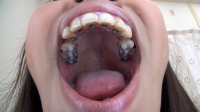 フェチ：泉水ちゃんの歯・口内自撮り 矯正歯(通常版＋３Ｄ）